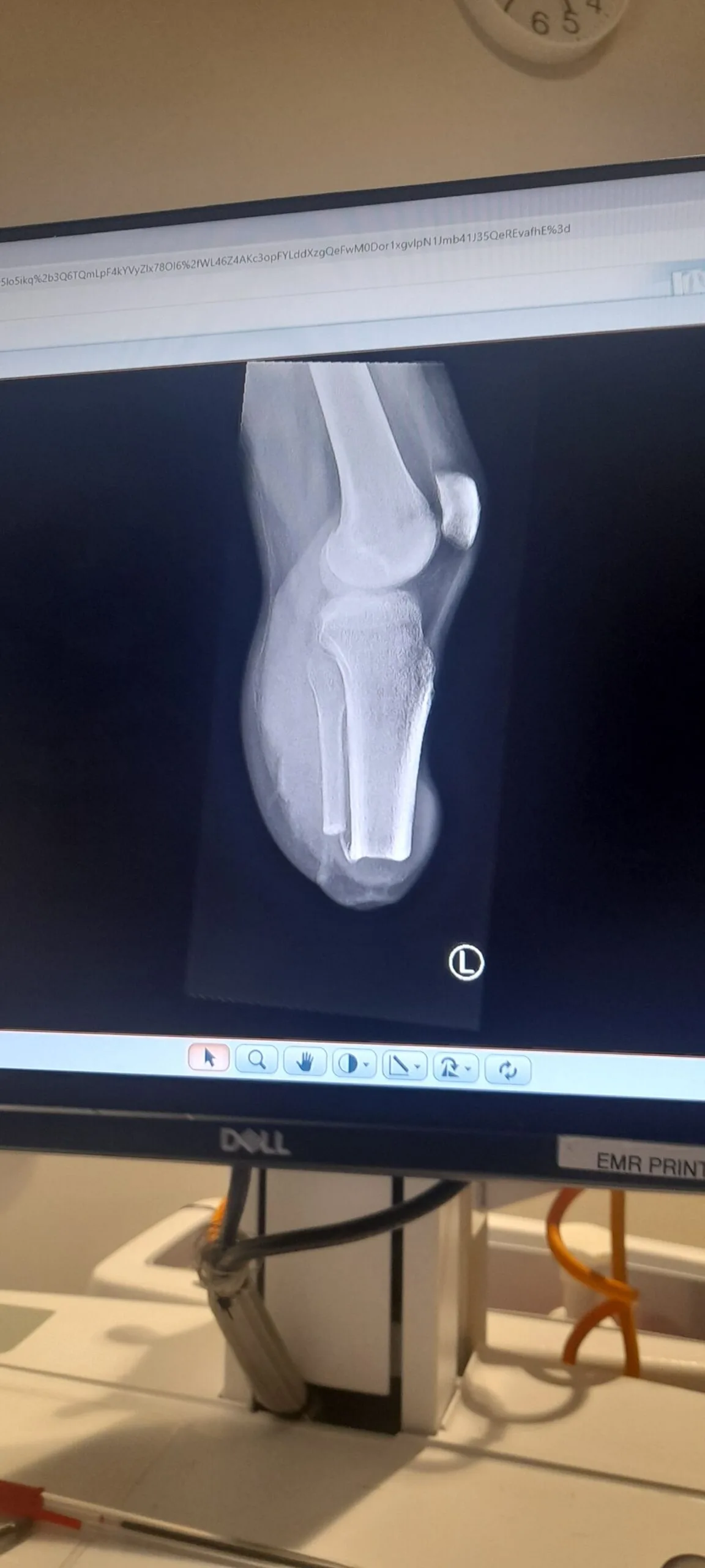 X-ray of leg on a computer. 