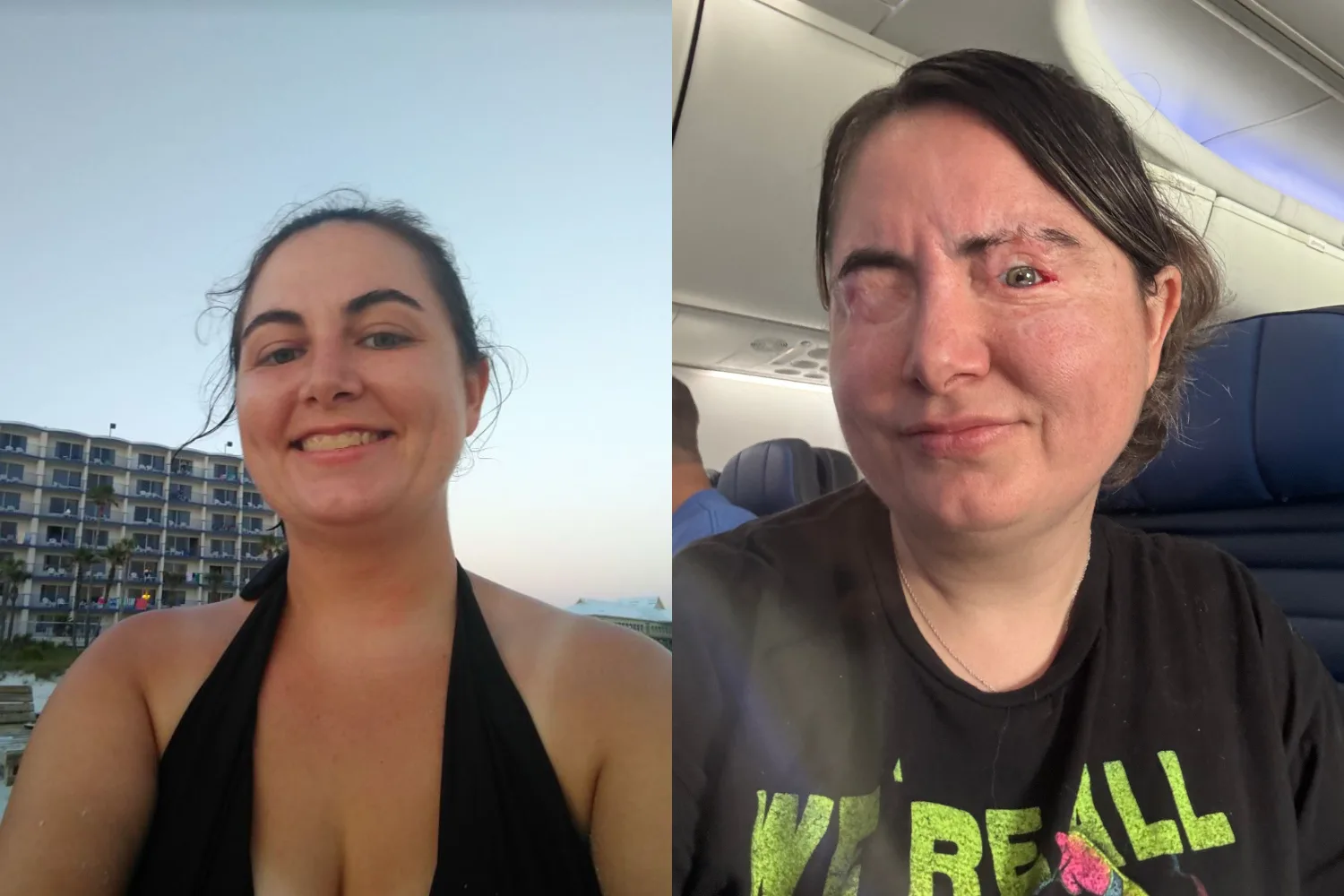 Left image - Woman before acid attack Right image - Woman after acid attack