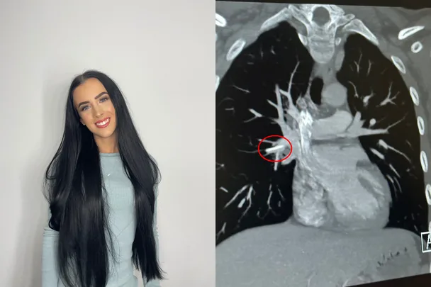 My Implanon vanished from my arm. Doctors found it in my heart!