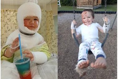 Right: Little boy covered in bandages sitting on hospital bed and holding blue drink. Left: Little boy with skin graft sitting on a swing and smilling at camera.