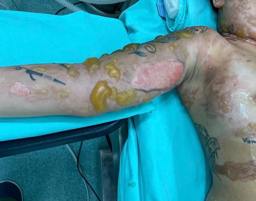 Image of burned arms