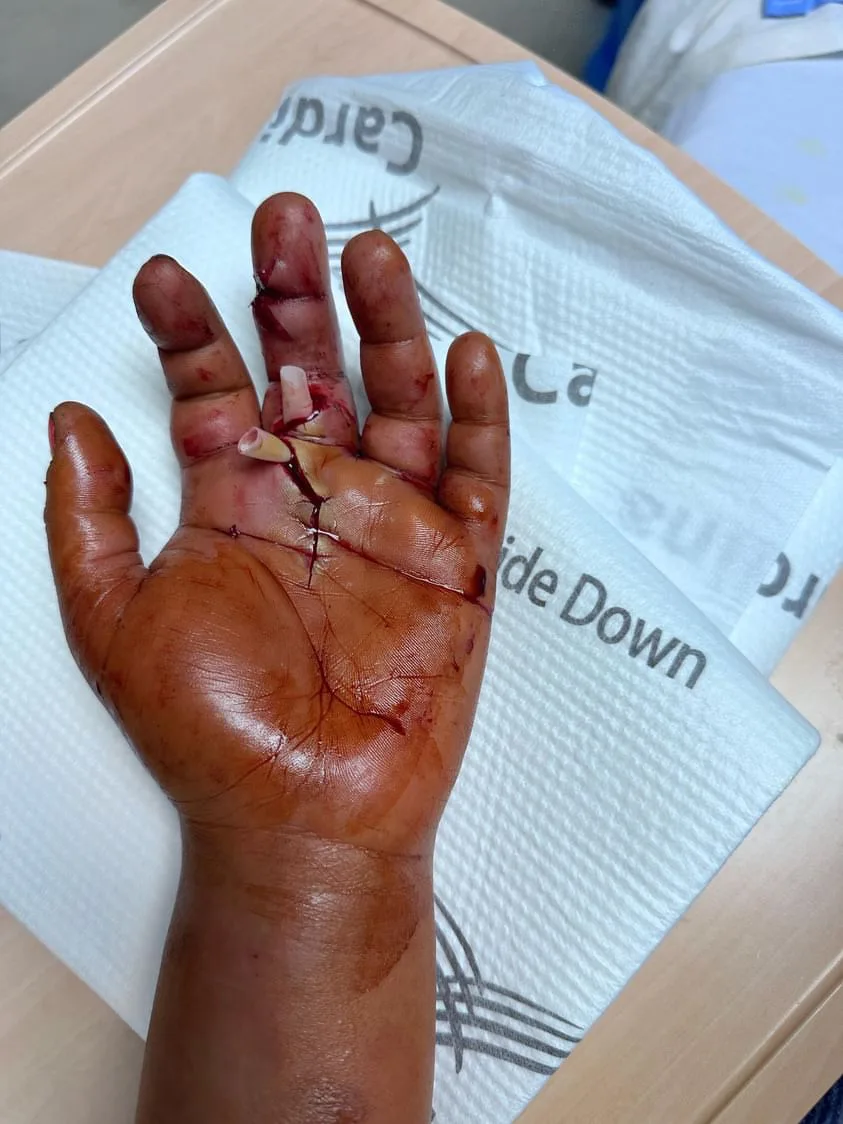 Image of hand after being impaled by a paintbrush
