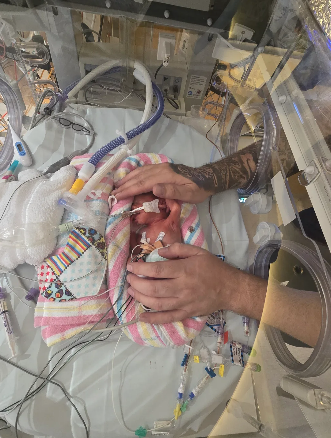 Premature baby in NICU with multiple tubes connected to the body.