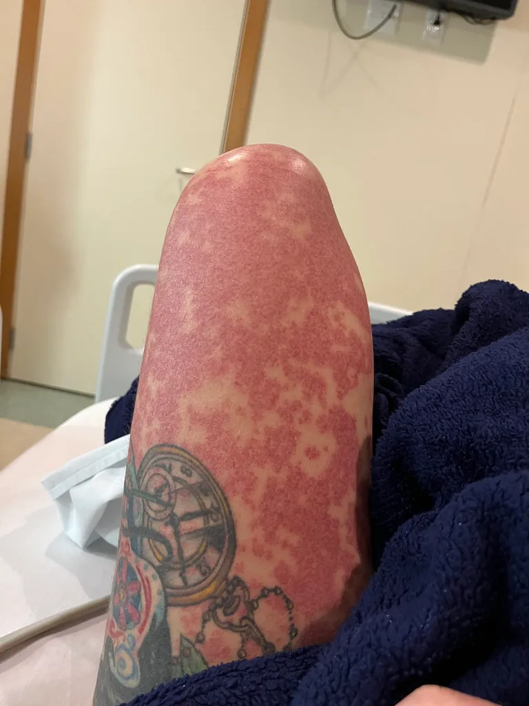 image of womans burned leg