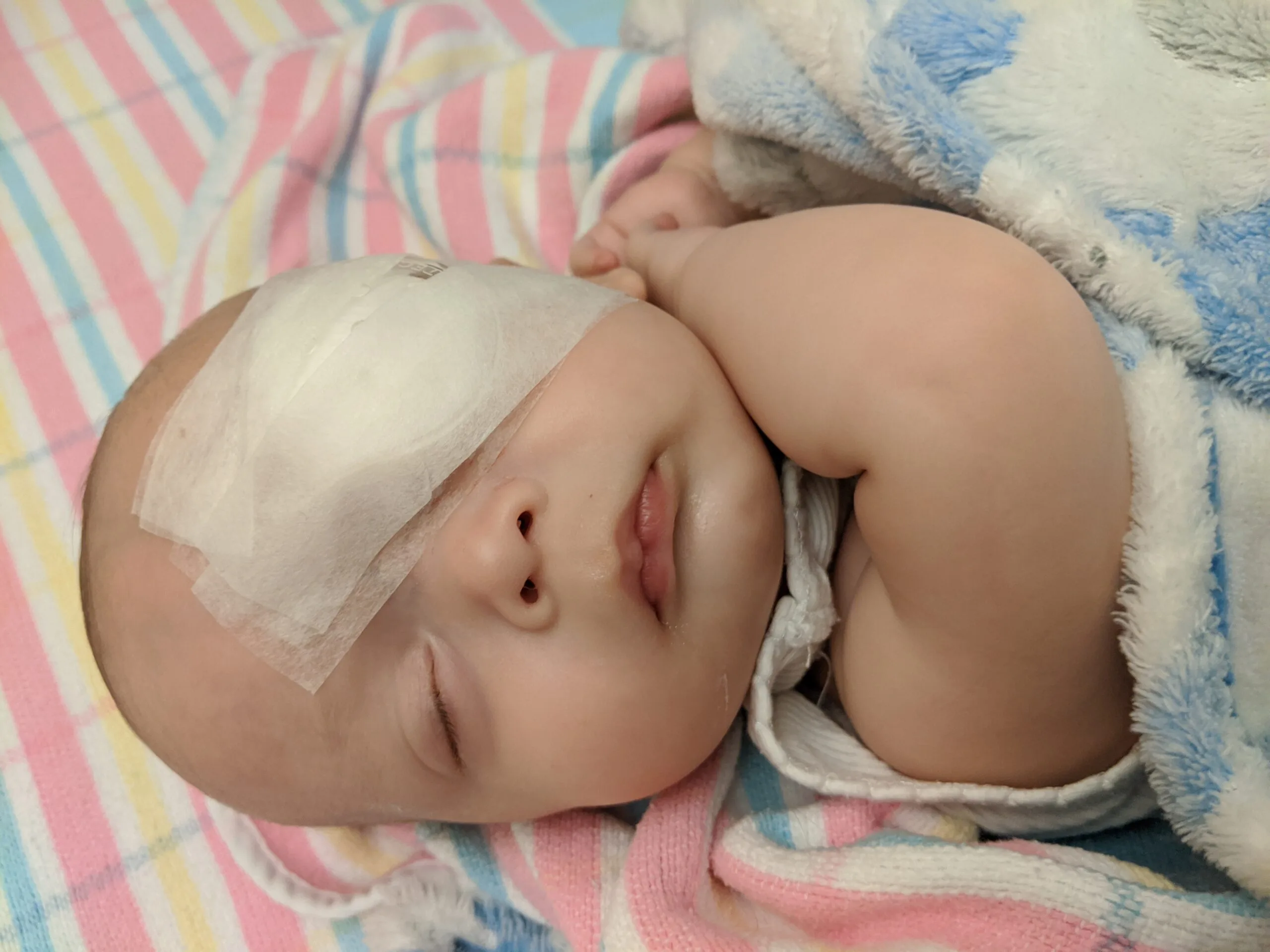 baby with white patch over eye