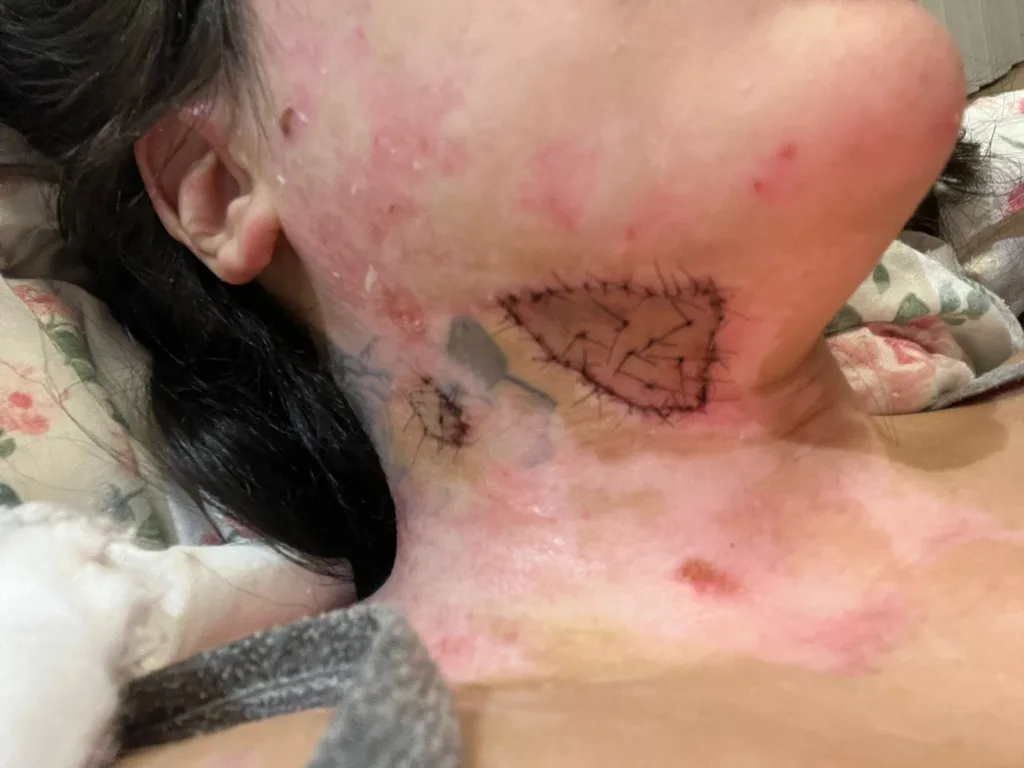 Image of womans skin graft after burns