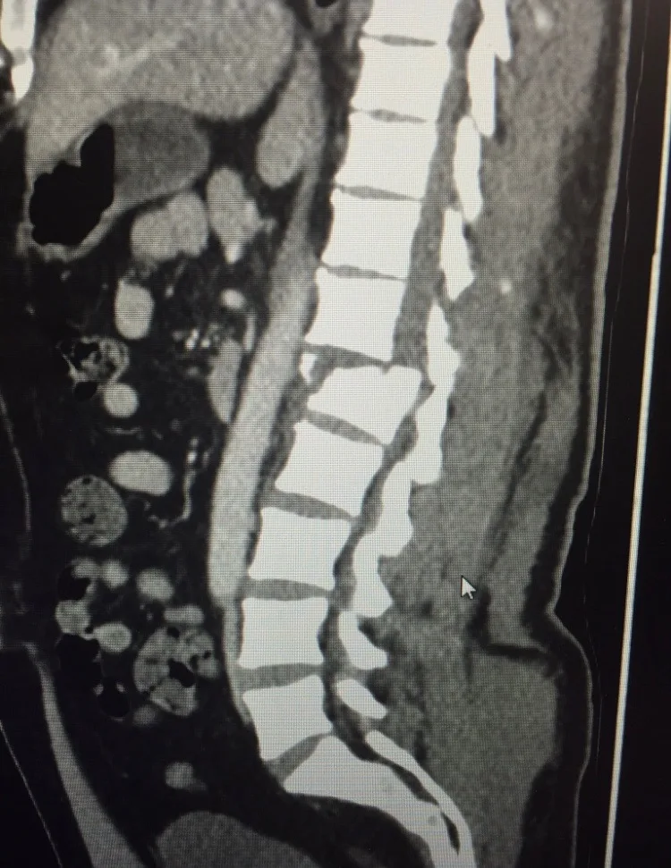 Image of fractured spine xray