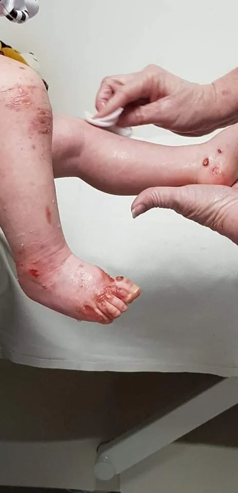 Xavier's burns