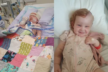 Left image - little girl recovering in hospital Right image - little girl recovering from surgery
