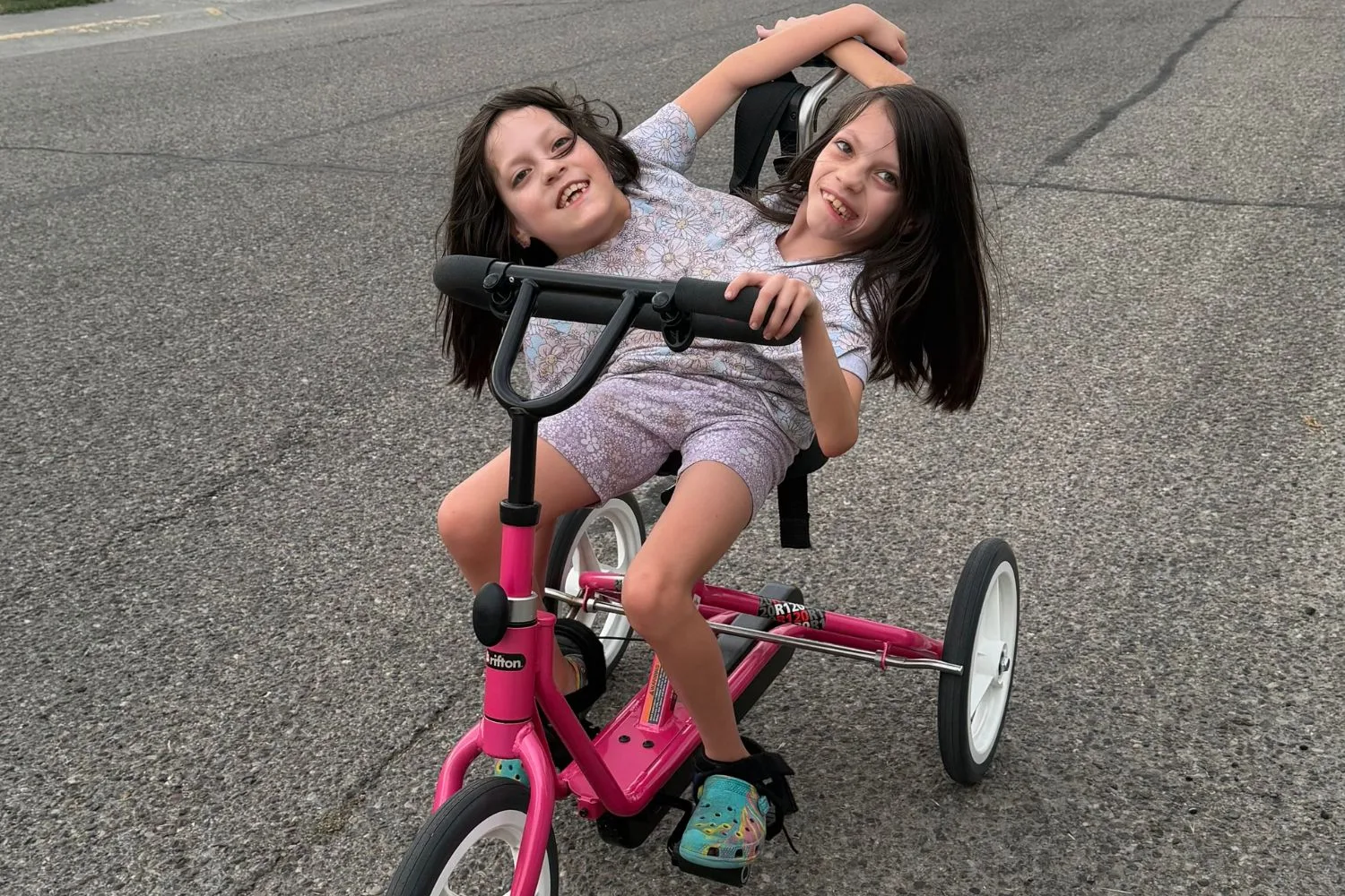 Conjoined twins Callie and Carter