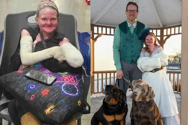 Rachel spends 18 hours a week bandaging her body- she hasn’t lost her love of adventure