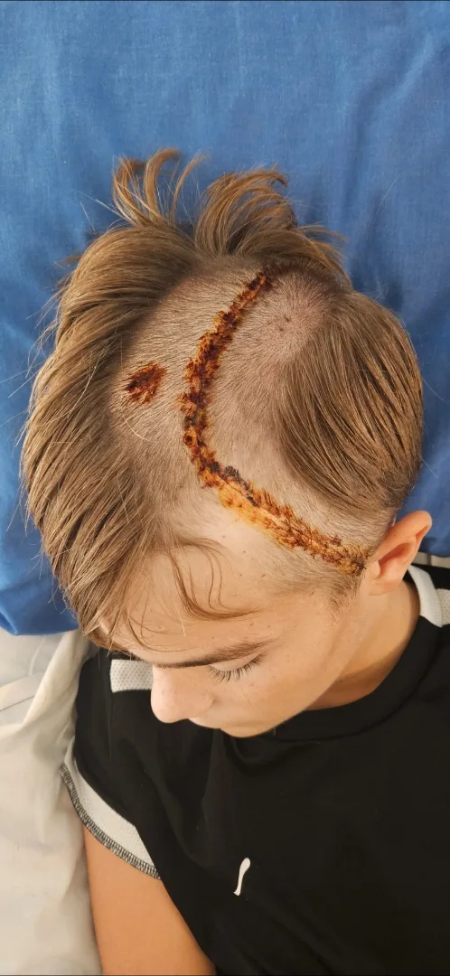 Image of young boy recovering from brain surgery