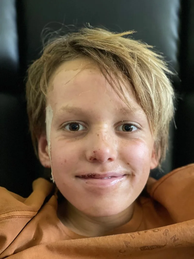Young boy with blonde hair, with healing skin, smiling at camera.