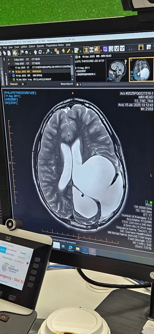 Image of CT scan showing brain tumour