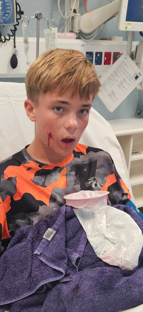 Image of young boy impaled in the cheek by bike handlebars