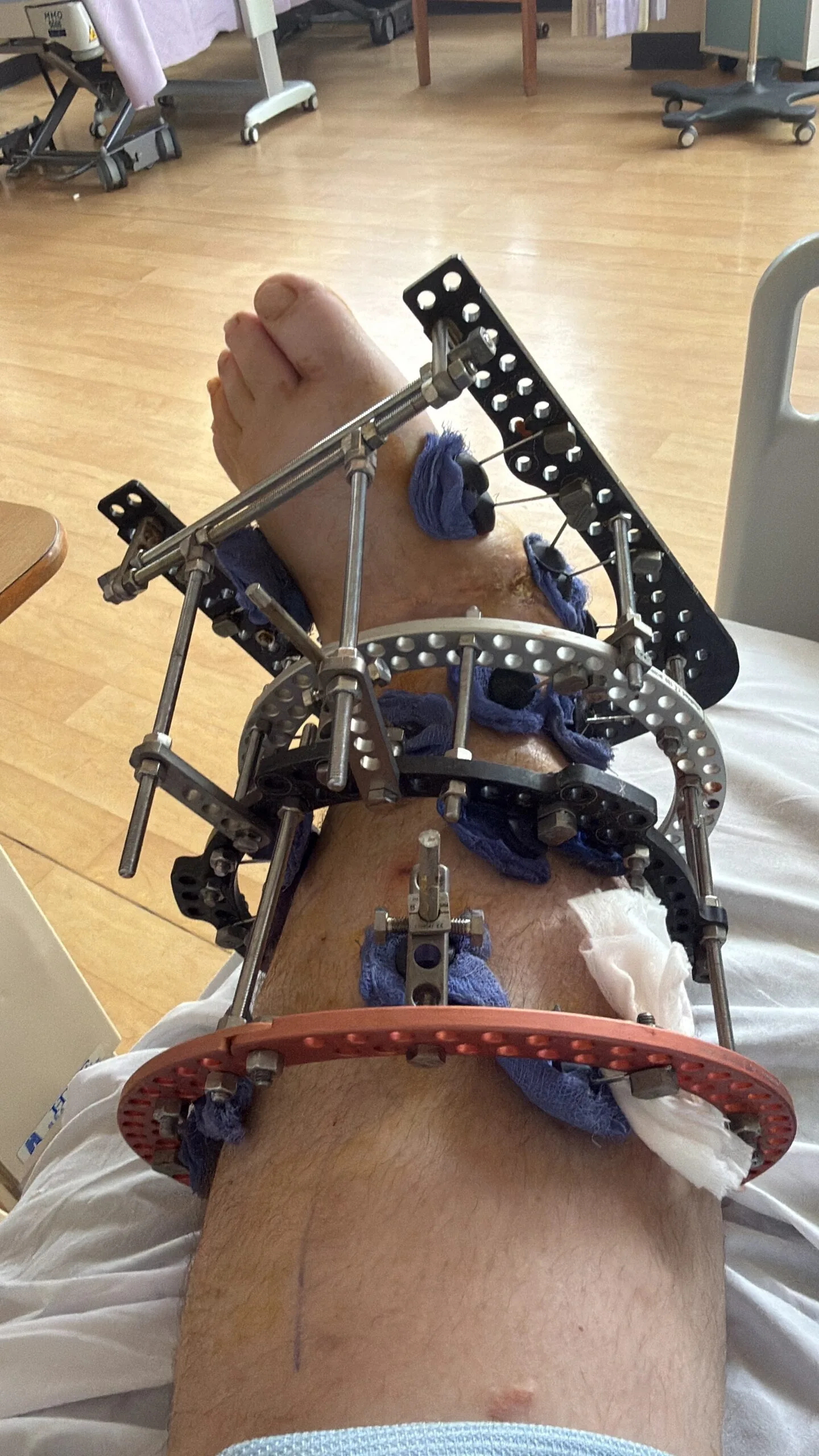 swollen foot in medicial device