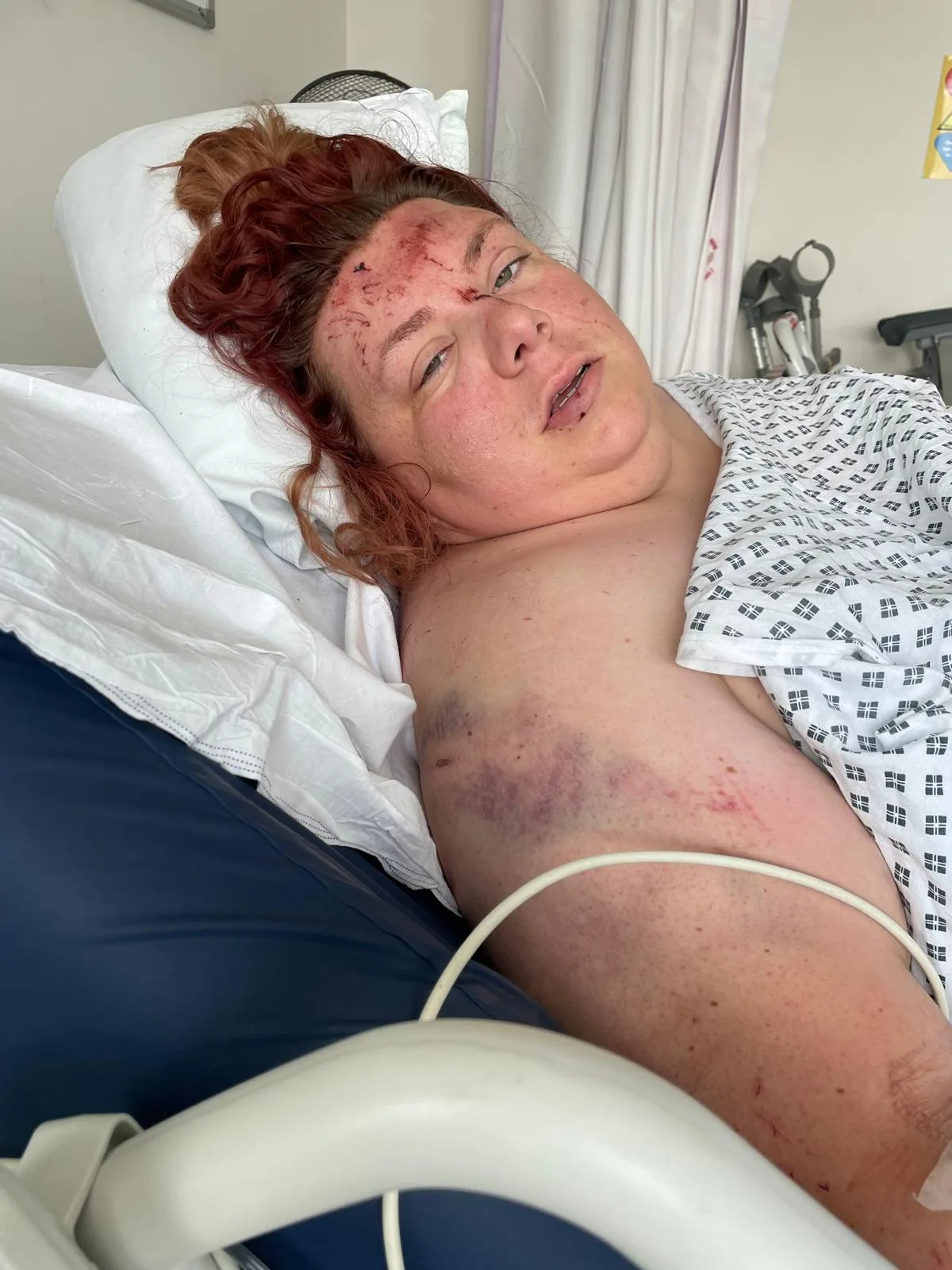 woman bruised in hospital bed