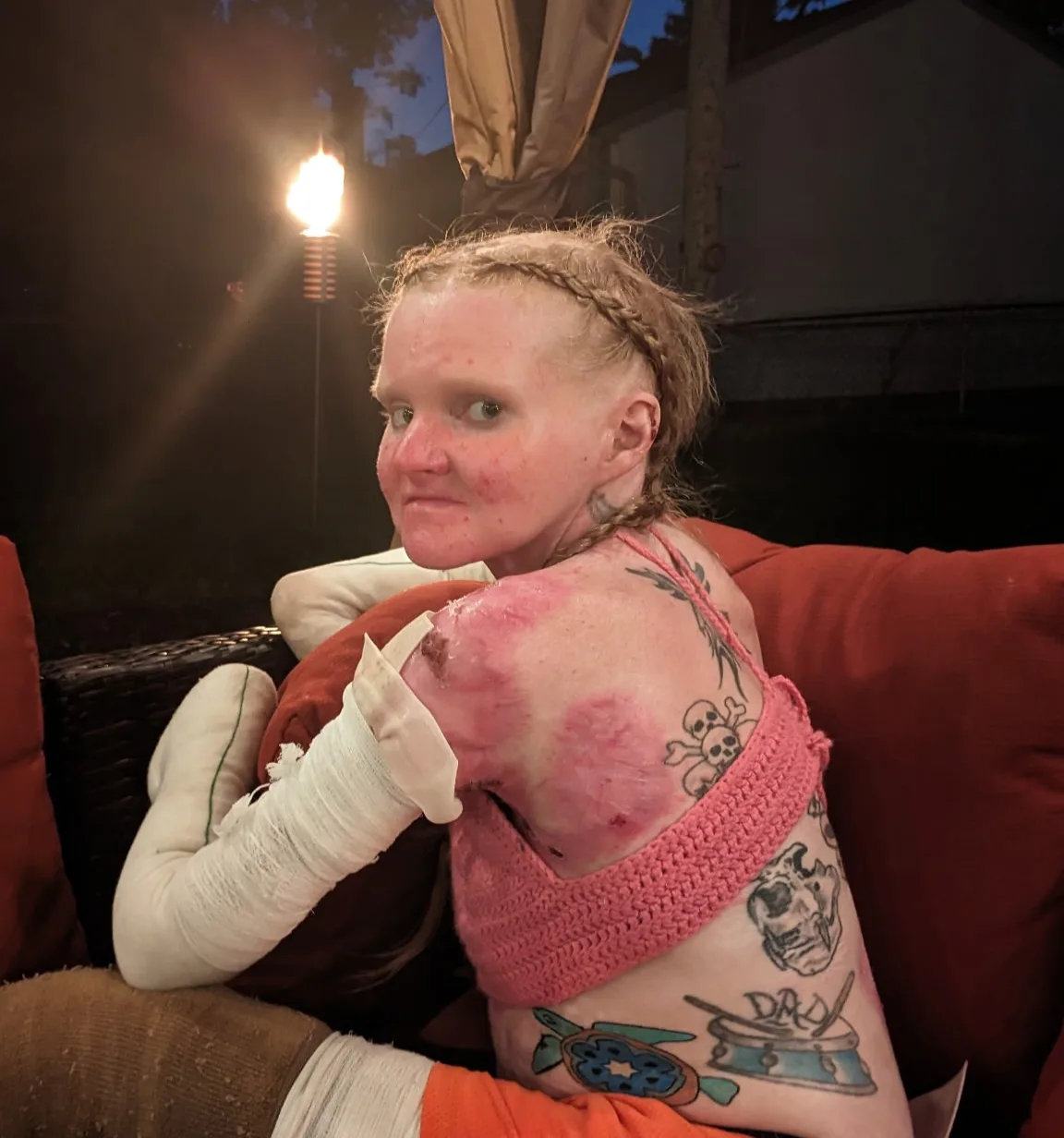 woman showing red skin on back