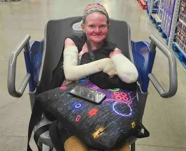 woman in wheelchair with arm banadages