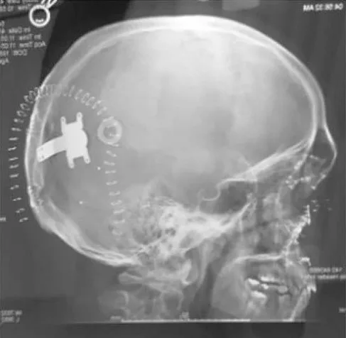The device in Jason's head