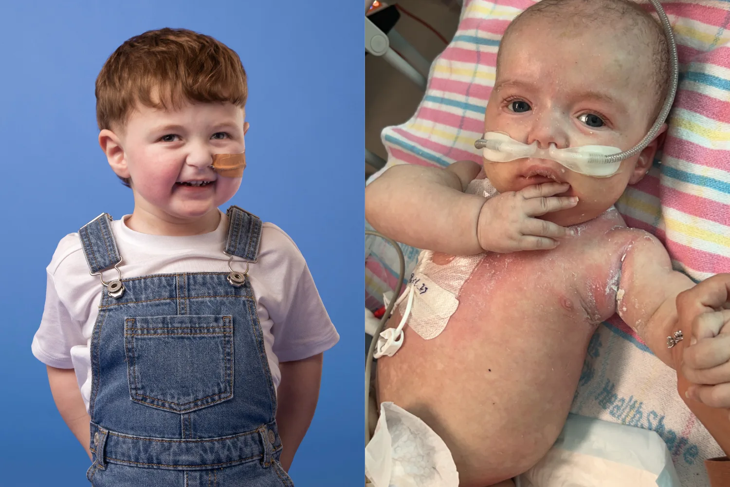 left: Toddler with feeding tube, wearing feeding tube and denim overalls, smiling at camera. right:Newborn baby in hospital with oxygen mask hooked to nose, staring at camera.
