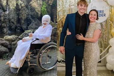 Left: Young boy covered head to toe in bandages sitting on a wheelchair. Right: Boy wearing blue suit wrapping arms around woman wearing gold dress, Both smiling at camera