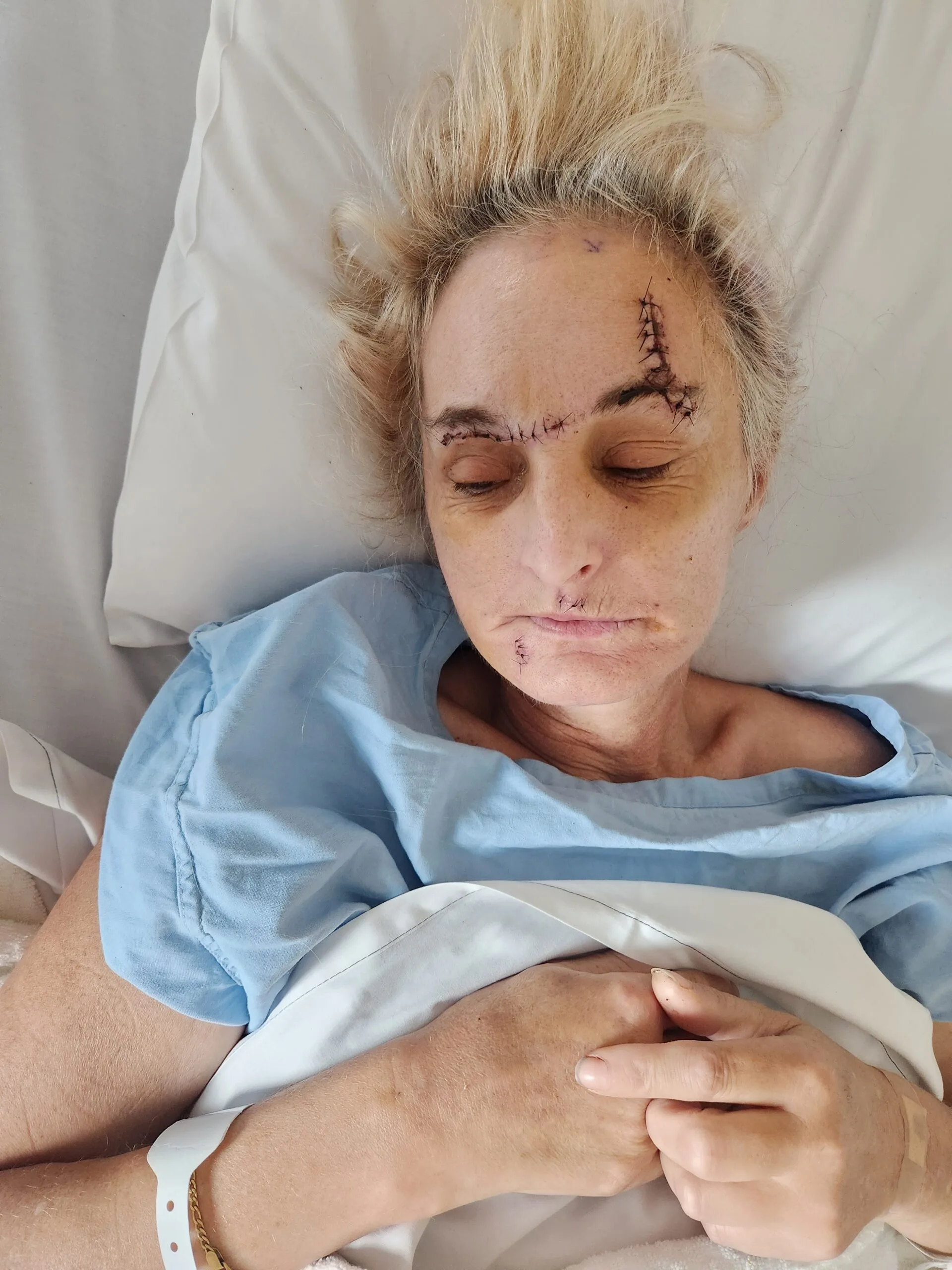 woman in hospital bed with stiches on head