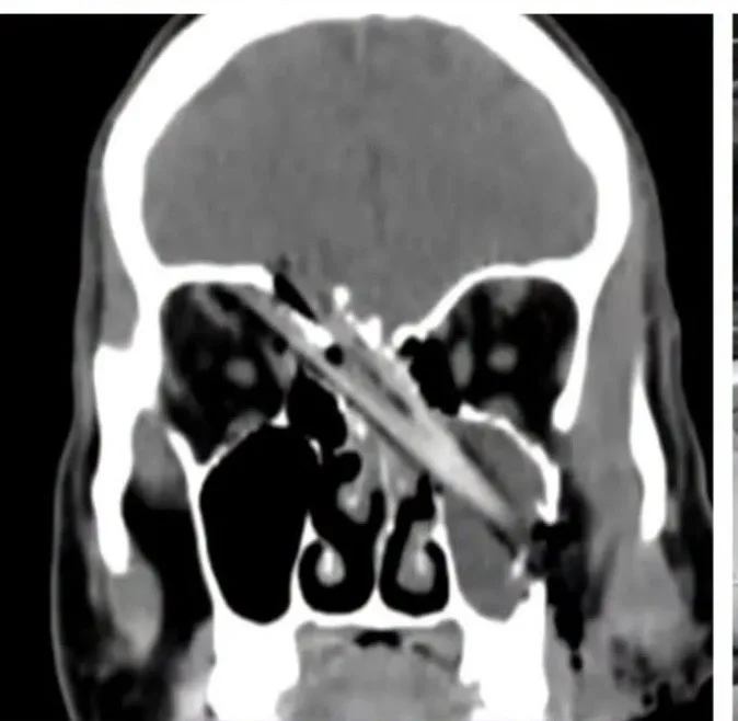 Image of xray impaled by branch