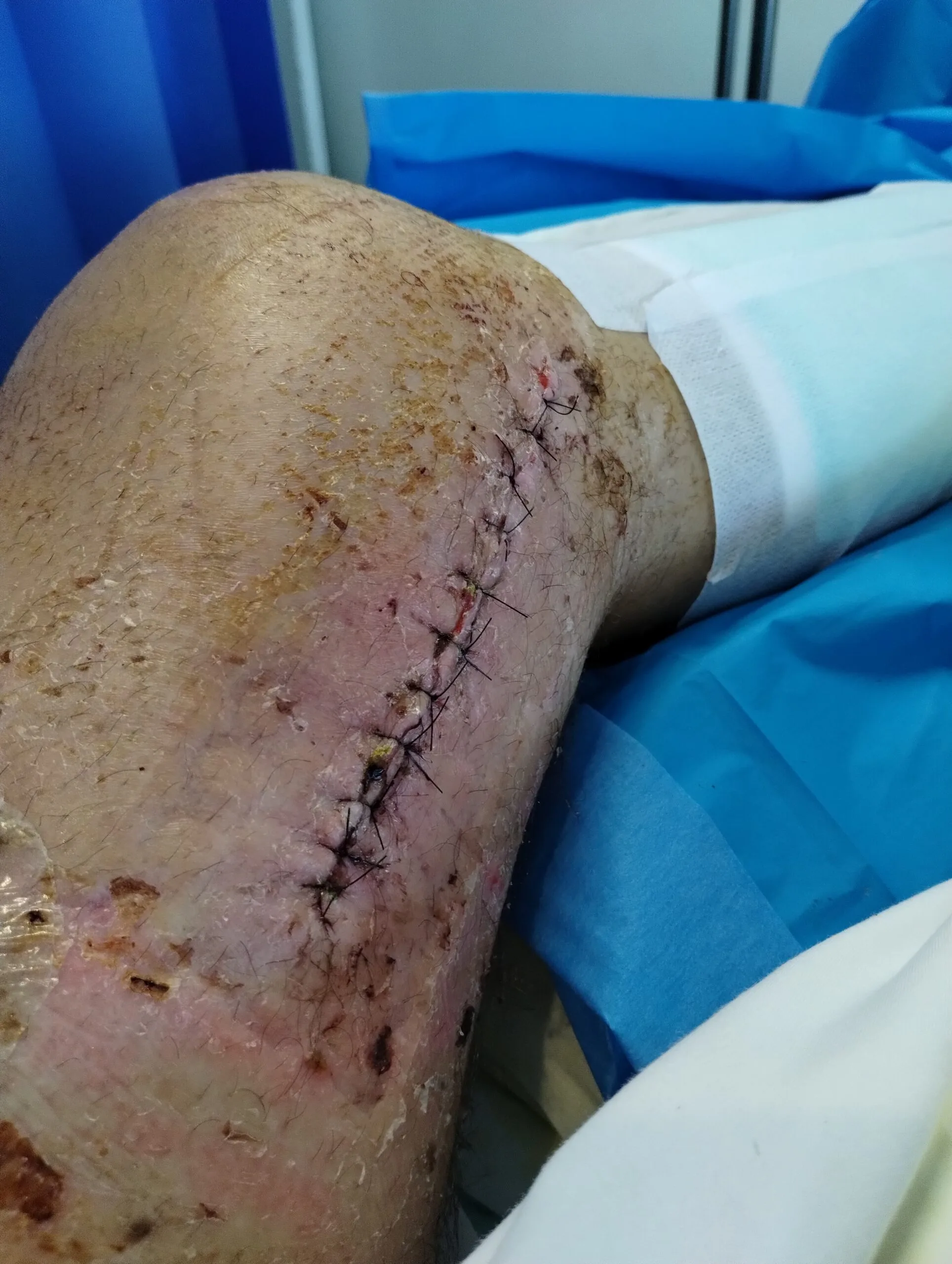 knee wound