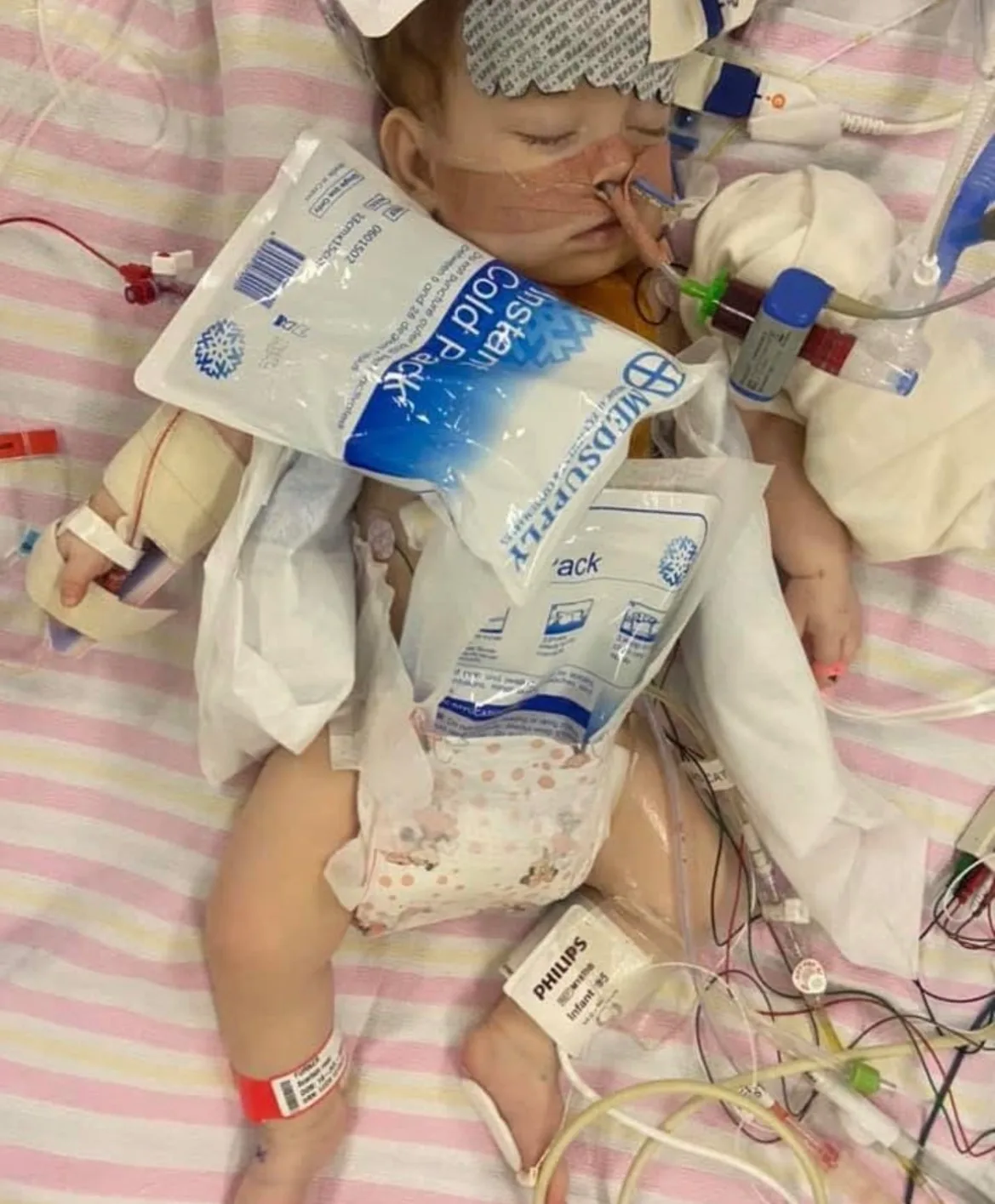 Newborn baby hooked onto multiple tubes and oxygen mask.