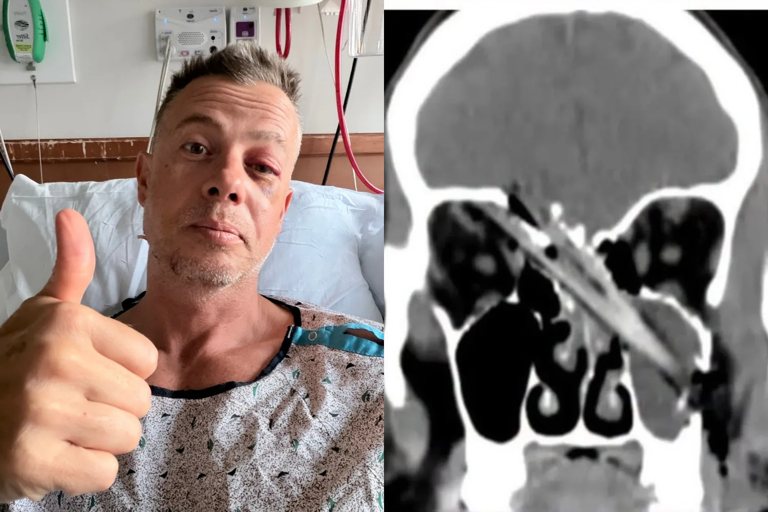 Left - Man recovering in hospital Right - xray of tree branch in face