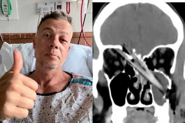 ‘It’s a miracle I’m alive’: Dad’s freak ladder accident left a branch lodged near his brain