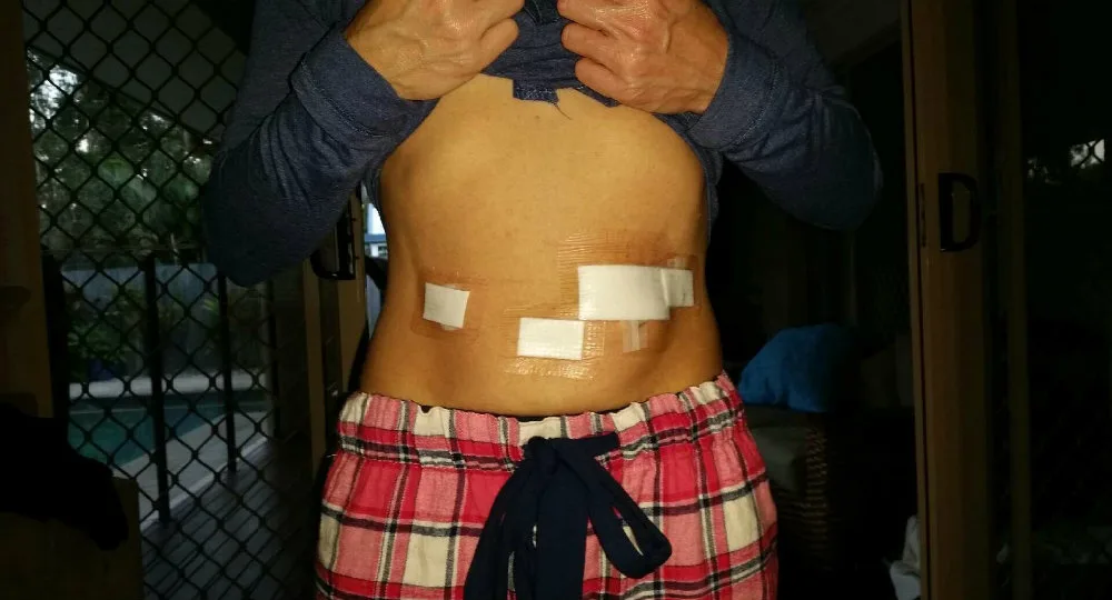 Kerryn Barnett battled gastroparesis