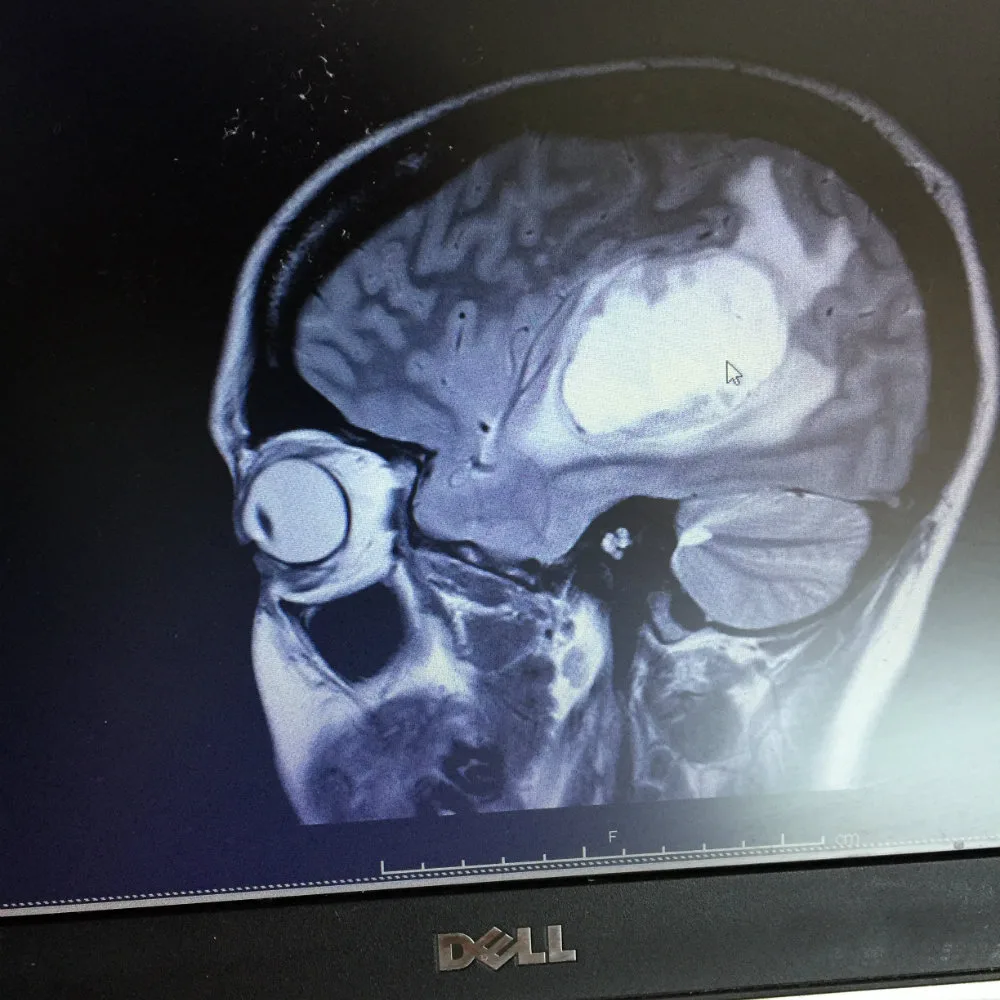 A scan showing the tumour in Felicity Plew's brain