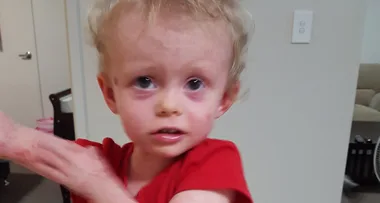 Mum’s heartbreak: My little girl is allergic to me