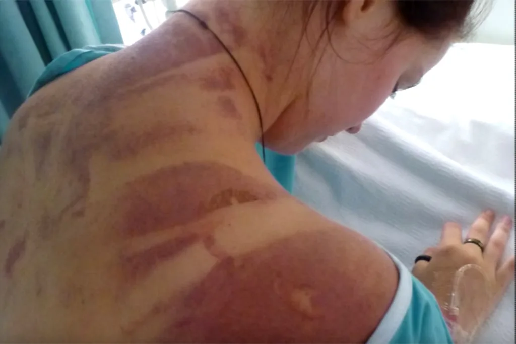 cord marks