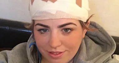 Woman’s horror warning: A DIY hair dye job left me bald