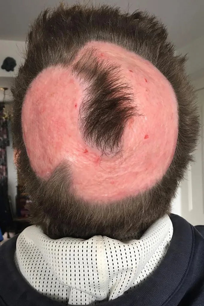 bald