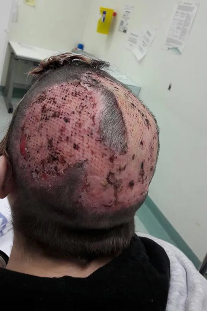 skin graft 1