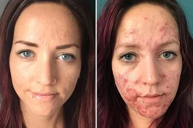 Woman with severe acne reveals how the agonizing condition left her too scared to go outside