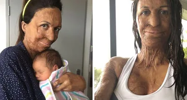Turia Pitt shares her struggle with breastfeeding