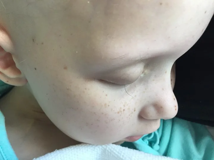This image of little Hayley Brown with just one eyelash remaining went viral