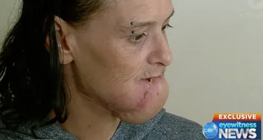 Aussie woman reveals horror facial injuries from dog attack