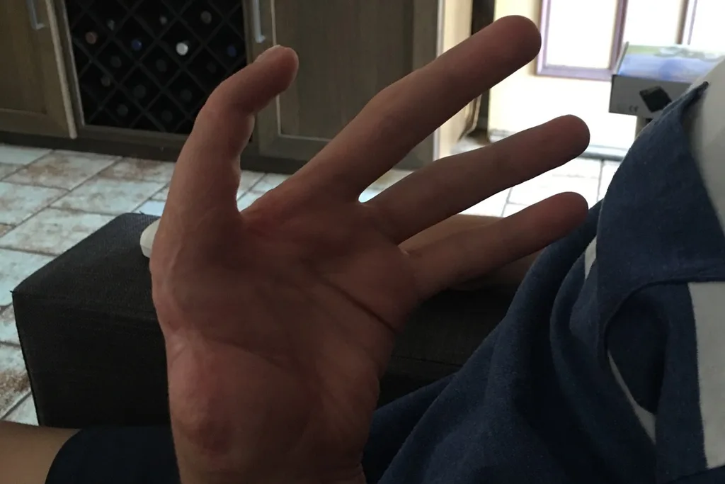new thumb