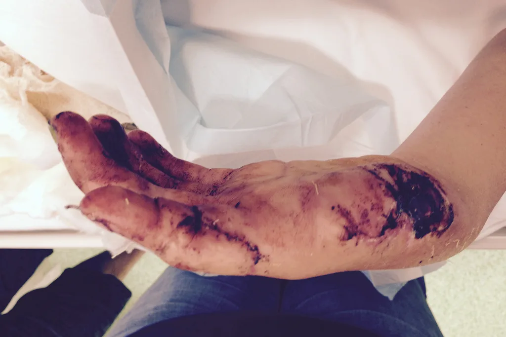 injured thumb
