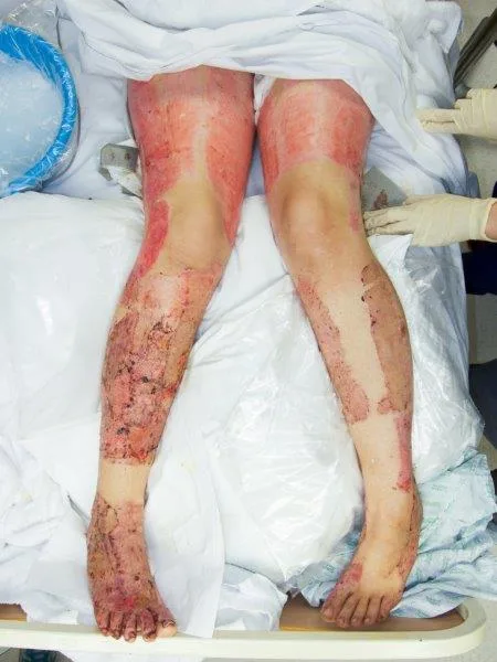 My feet were severely burned