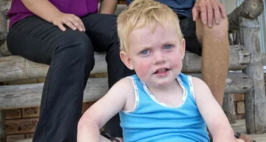 The toddler who is allergic ‘to almost everything’