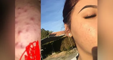 This woman’s cure for cystic acne is going viral