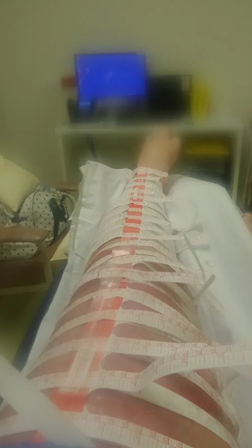recovering leg