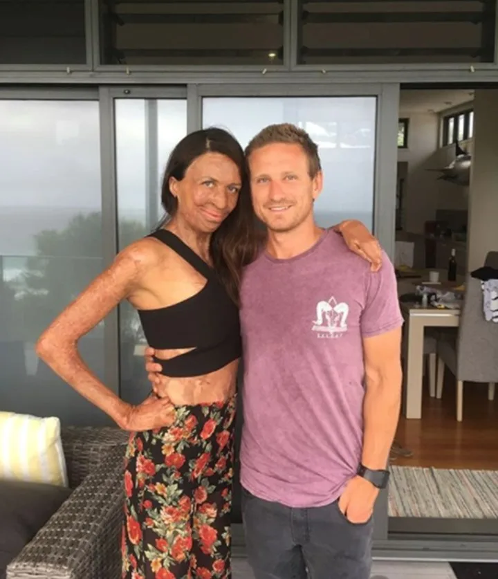 Instagram/Turia Pitt